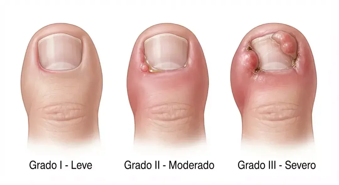 Comparación visual de los diferentes grados de una uña encarnada.