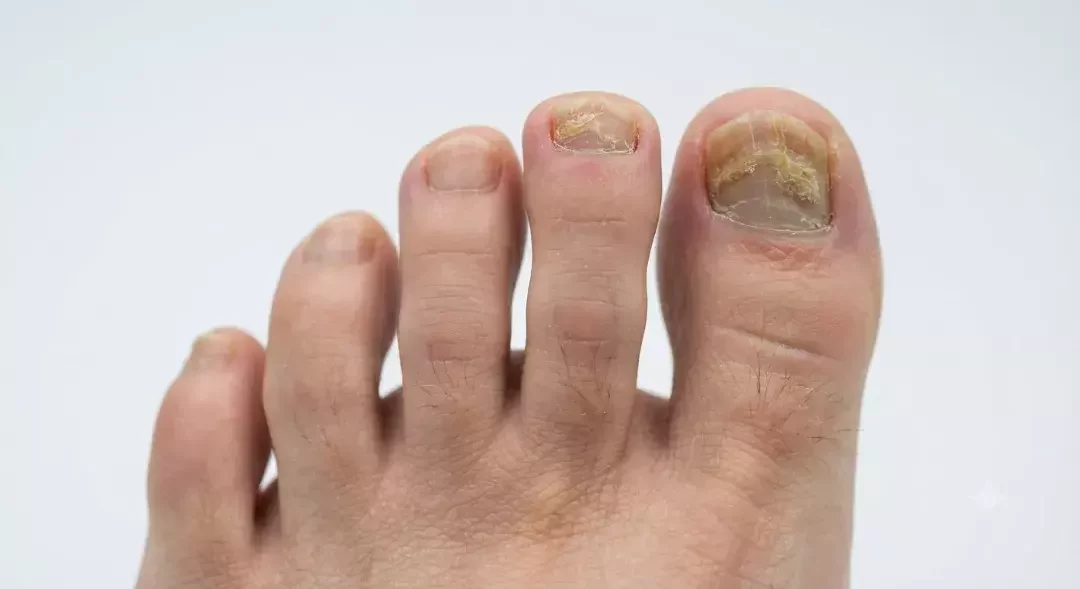 Uñas amarillas y gruesas como síntomas de onicomicosis.