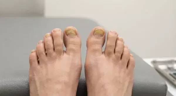 Tratamiento para hongos en las uñas con cambios de color y engrosamiento.