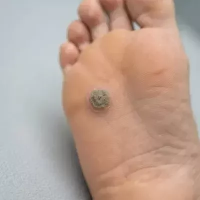 Verruga plantar en la planta del pie con características visibles de la lesión.